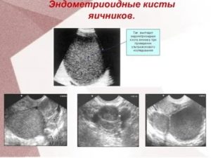 Почему возникает эндометриоидная киста яичника