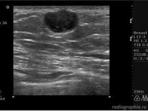 Если узи показывает очаговое образования в молочной железе