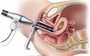 Гистероскопия биопсия эндометрия с гистологическим исследованием
