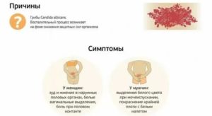 Как применять корицу при молочнице