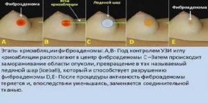 Можно ли принимать дюфастон при фиброаденоме молочной железы