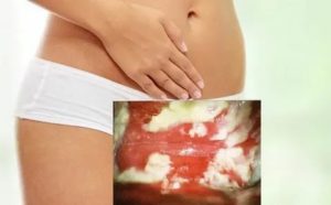 Меня молочница сильный зуд от чего может быть и чем лечить