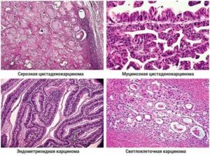 Серозный папиллярный рак яичников
