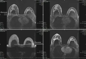 Мрт молочной железы с контрастом что показывает