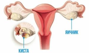 Почему при кисте яичника нельзя загорать