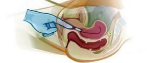 Введение препаратов во влагалище