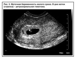 Узи признаки маточной беременности малого срока