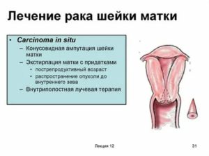 Повышение температуры при раке матки может быть