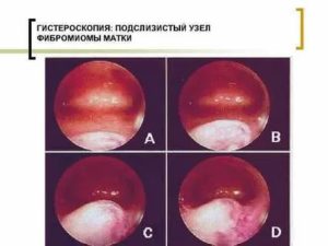 Что такое гистероскопия при субсерозной миоме матки