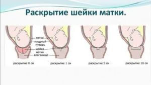 Влияние дюфастона на раскрытие шейки матки