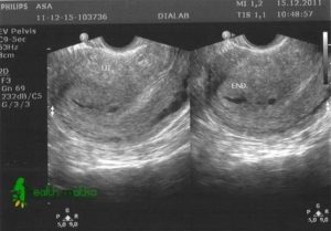 Узи матки на какой день цикла делать при аденомиозе