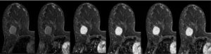 Мрт молочной железы с контрастом что показывает