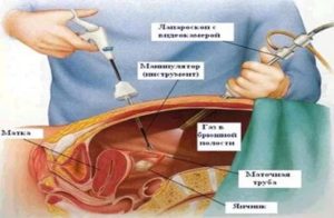 Пункция при диагностики внематочной беременности