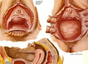 Опухоль во влагалище после родов что это