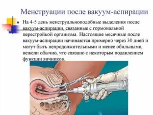 Какие должны быть месячные после диагностического выскабливания