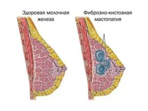 Можно ли делать массаж груди при фиброзно-кистозной мастопатии
