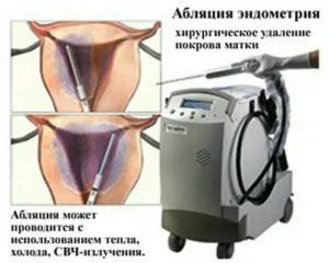 Абляция эндометрия при эндометриозе