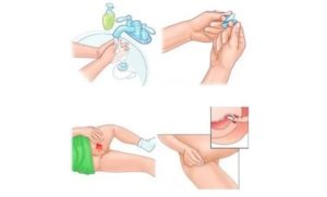 Введение препаратов во влагалище