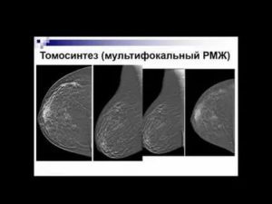 Нейроэндокринные опухоли молочной железы