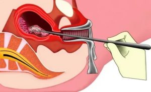 Гистероскопия матки при замершей беременности