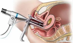 Гистероскопия маточных труб что это такое