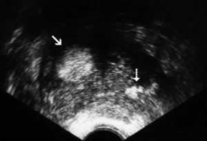 Эхогенность повышенная в предстательной железе что это такое