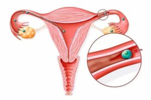 Что делать если не закрывается матка после месячных
