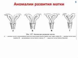 Пороки развития матки методы диагностики