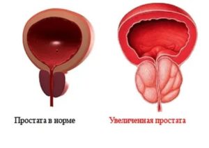 Грибковые заболевания предстательной железы