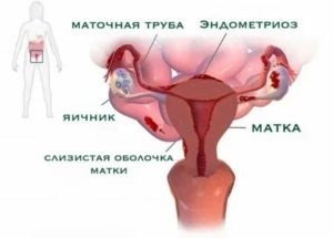 Можно ли при эндометриозе матки крутить обруч