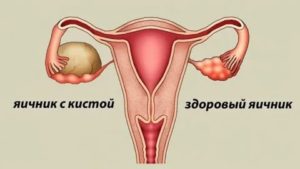Могут ли образовываться кисты яичников при приеме ярины