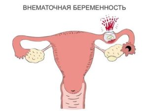 Может ли быть внематочная беременность при менопаузе