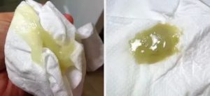 Могут ли быть при климаксе зеленоватые выделения