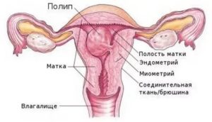 Может ли полип эндометрия выйти с месячными сам