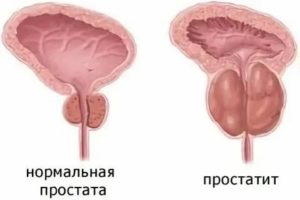 Брусничный лист при аденоме простаты