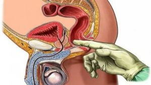 Что такое ректальный массаж при простатите