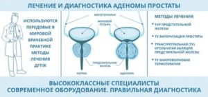 Эхинацея при лечении аденомы простаты