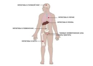 Химиотерапия при раке простаты с метастазами костей отзывы