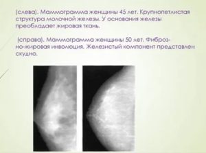 Что такое диффузная фиброзно-кистозная мастопатия на фоне жировой инволюции