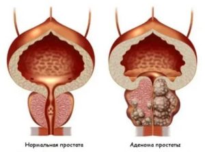 Аденома простаты анемия