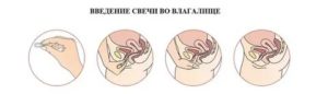 Введение препаратов во влагалище
