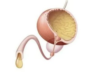 Урологическое заболевание молочница википедия