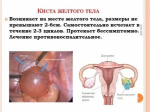Как влияет утрожестан на кисту желтого тела