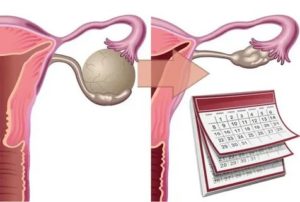 Могут ли пройти кисты яичников после месячных
