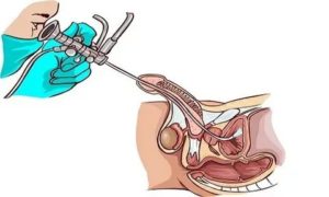 Бужирование предстательной железы у мужчин