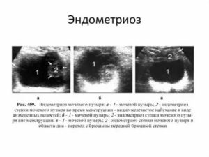 Как диагностировать эндометриоз брюшной полости