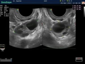 Чтобы пройти узи яичников что для этого нужно