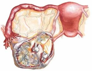 Опухоль яичника опасно или нет
