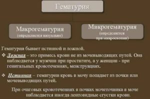 Лечение антибиотиками при гематурии у мужчин