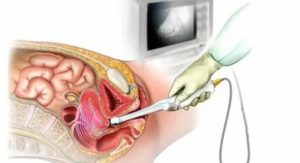 Как почистить кишечник перед узи матки